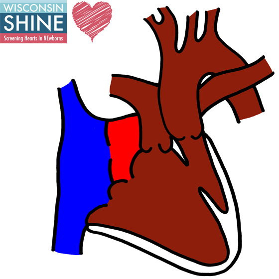 Complex Single Ventricle Disease (Double Inlet Left Ventricle with Ventricular Inversion)