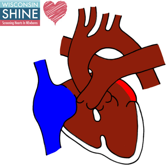 Type I Tricuspid Atresia (TA)